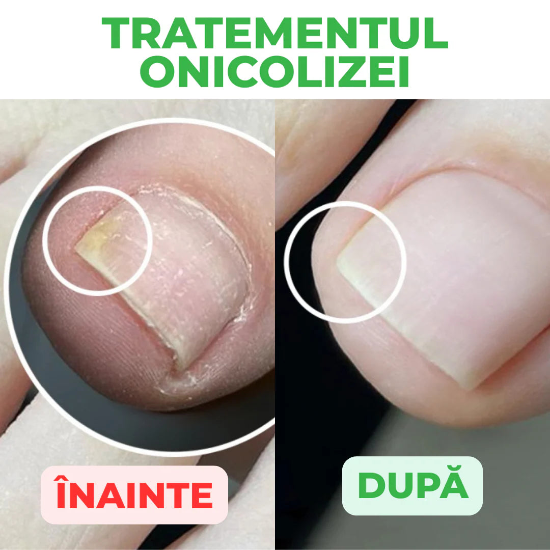 StraDerm Active Care – Tratament Antimicotic și Antibacterian pentru Unghii și Piele 30ml