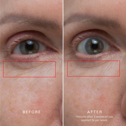 Karuna Age Rewind Microneedle Patches, plasturi cu microace, retinol și peptide pentru riduri
