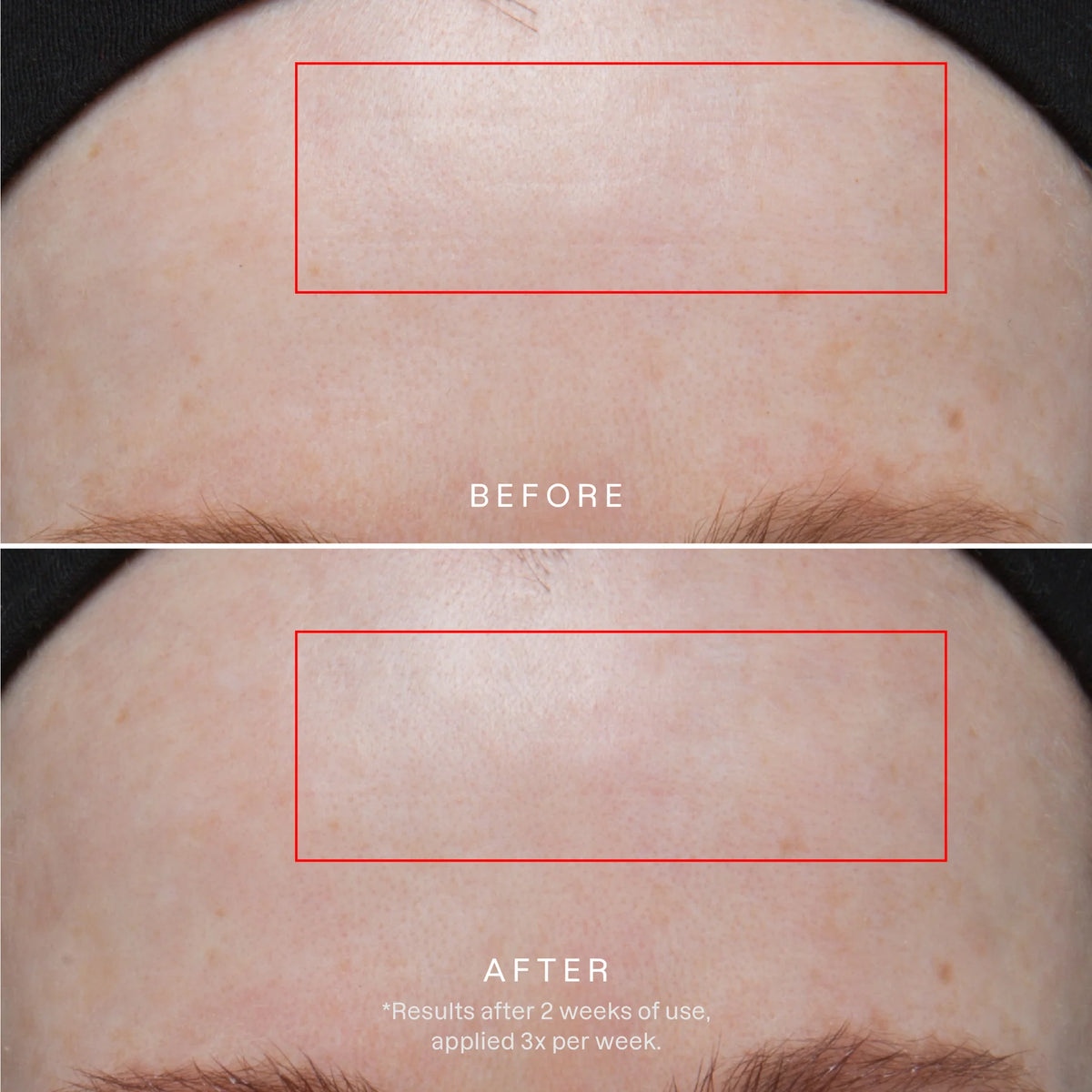 Karuna Age Rewind XL Microneedle Patches – plasturi XL cu microace, retinol și peptide