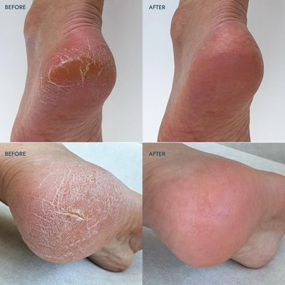 Balsam stick pentru calcaie uscate Voesh Heel Repair Balm